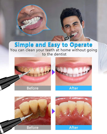 (👨‍⚕🦷Buy 2 Free Shipping)Electric tooth cleaning instrument -Teeth Cleaner